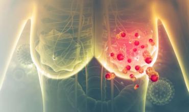 Milagro: Un nuevo tratamiento para el cáncer de mama logra un 100% de supervivencia