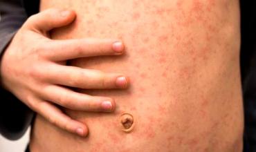 Sarampión: cómo se contagia, quiénes deben vacunarse, quiénes no y, ¿es mortal?