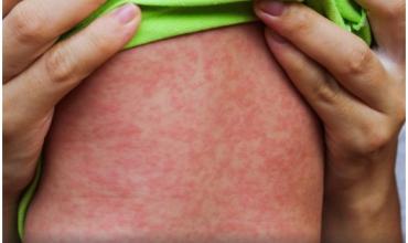 El país de América que perdió el estatus de libre de sarampión y cómo afecta a la Argentina y al resto de la región