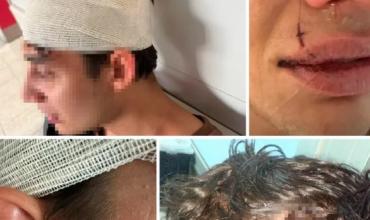 Un joven denunció que fue brutalmente atacado por rugbiers cordobeses a la salida de un boliche en Mendoza
