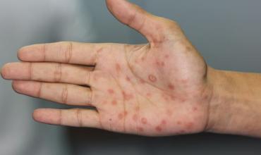 Alerta por sífilis: los casos alcanzan cifras récord en la Argentina y crecen sobre todo entre los jóvenes