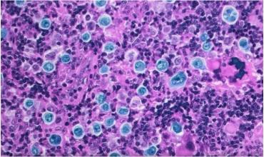 Médicos israelíes lograron un avance impensado en el tratamiento de un tipo de cáncer