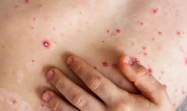 Claudio Strasorier, médico infectólogo, sobre el primer caso de viruela símica en el país: “Es una cepa más contagiosa, pero la enfermedad es autolimitada”