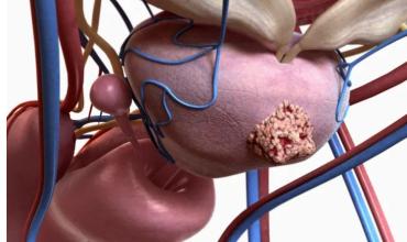Cáncer de próstata: más de 13.000 casos al año y 70% de diagnósticos tardíos refuerzan la importancia del PSA