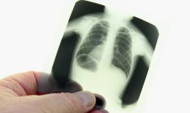 Se registraron más de 38.000 casos de bronquiolitis