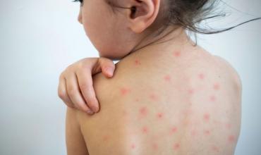 Brasil refuerza vacunación y vigilancia ante avance de sarampión en América