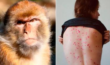 Viruela del mono: todo lo que hay que saber de la extraña enfermedad que preocupa a Europa y Estados Unidos