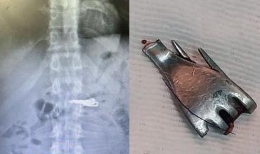 Santa Fe: un preso de alto perfil se tragó un tenedor en la cárcel y terminó internado bajo estricta custodia