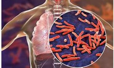 Aumentaron un 38% los casos de tuberculosis en Argentina